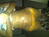 5 Days after Lipo