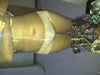 10 days after Lipo
