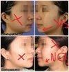 see how on top where i said yes pointing towards her chin.see how much pointy and small it looks after losing that much skin fat.is it posible?mines kinda looks like the ones on the buttom and i hate it