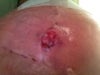 open wound left breast 
three weeks out of surgery