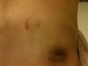 teethbite scar on my body