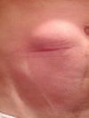 You can see the lump above the scar