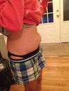 Tummy is usually VERY flat...Ive also noticed its spread somewhat across lower part of belly.  This pic was taken day it came up..which was overnight.  Docs just can't seem to find answers..going on 3 weeks now..very tender..discomfort