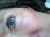 Photo of eye area