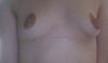 After Breastfeeding (1 month after stopping completely) picture taken today