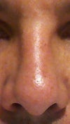 Left bridge and left side of my nose now are uneven. I want to