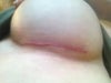 inframmanry breast incision following breast augmentation.