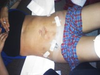 2 days post op