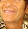 Significant changes developing years after lip filler. (1993 non-FDA approved synthetic Fibrin).