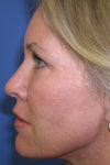 THIS IS NOT Me, but do you see where her cheek fat and end of lips don't meet? IMine's oddly do. Imagine too much fat(or muscle) extend from the cheeks and connect to the lips. you'll get one big blob of flabby fat cheeks.  My lips literlaly stick out b/c of the fat. The difference with my left side is the fact that the cheek fat completly slide down, continuing to drag down more face fat.