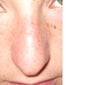 close up frontal before surgery