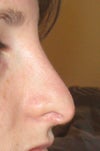 profile 1 year after surgery