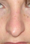 close up frontal 1 year after surgery