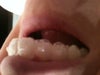 Right canine and lateral incisor with spaces