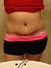 6 weeks post op