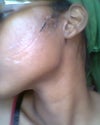 The  cut on my face as it is now.