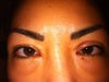 1 month after surgery