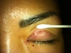 1 month after surgery