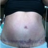 11 months after tt - showing unattractive BB and stretched out bikini line scar.