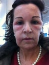 Face three weeks after Dysport injection