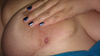 Best I can do for a picture. This is the under neath of my breast btw