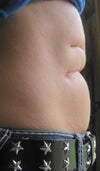 Side view to see depth of scar