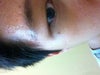 Brown scar after mole removal