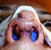 bulges inside the nostrils/ tip