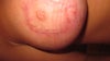right breast-areola stretching,scar widening and healed wound