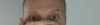 eye different size & eye brow higher on right side of my face