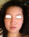 6 months since restylane injection