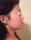 6 months since restylane injection