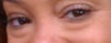 Before trans bleph smiling
