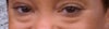 Before trans bleph smiling