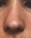 Deviated nose