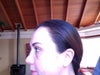 Side view of how nose projects right in middle after small dent. Feels like fibrosis, is hard where is looks bumpy and is sensitive.