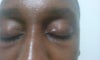 One eye, but its on both eyes