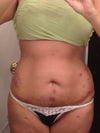 A few days post-op