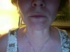 The two white areas under my bottom lip are filled with product. Above my left (rt on photo) lip I have a piece that feels like macaroni under the surface. Is broken blood vessels common with this?
