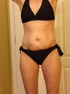 Before- you can see the incisional hernia on my left side. This is where I had a previous back surgery.