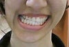 the imbalnce which is clearly shown when i open my mouth wide...its not so visble when i smile because when i smile my lower teeth  are not really visible...only my front upper teeth show when i smile