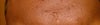 Around the middle of forehead, and indented.