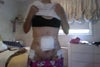 Front 12 days post op
