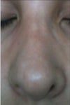 post op 3 months