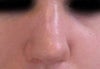 Nose bridge horrible