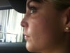 see how cheek sticks out causing eye hollow, I have to use so much concealer now to hide eye hollowing