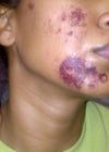 next day after burn