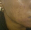 Wound completely healed but extreme white blotches vs my natural brown skin ( hard to see in pic but its 2 completely diff colours)