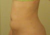 8 weeks of wearing a compression garment for 12 hours....   no change!?