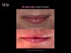 This is a picture I had found from a plastic surgeons website of a lady who got botox and fillers in her lips for a more defined look. Is this achievable?